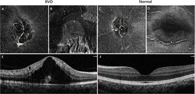 Characterization of Macrophage-Like Cells in Retinal Vein Occlusion Using En Face Optical Coherence Tomography